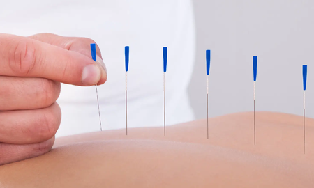 Mitos y verdades sobre la acupuntura
