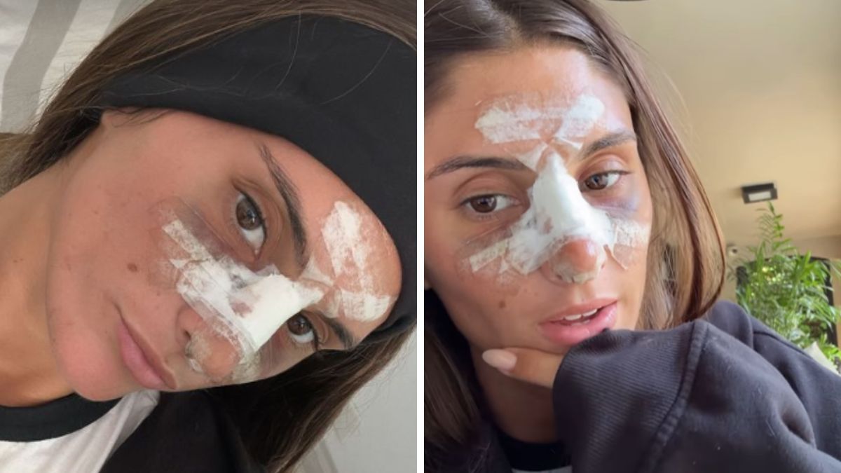 Lola Latorre se sometió a una cirugía estética. Lola Latorre se sometió a una cirugía estética.