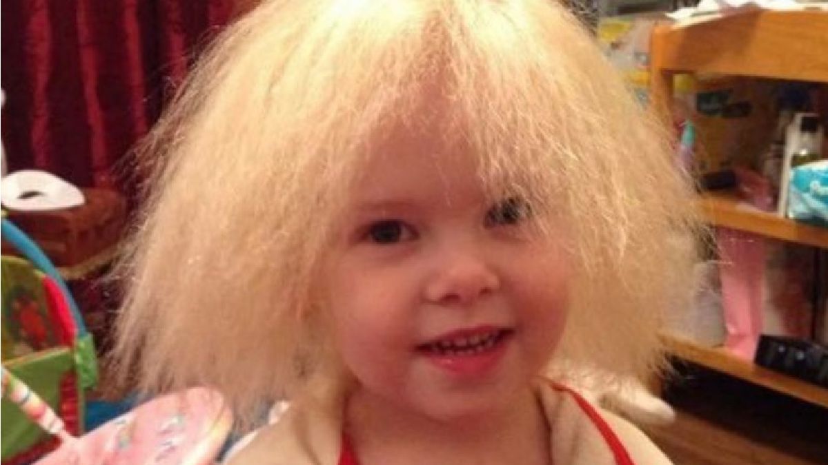 Lyla Grace la nena que no se pudo peinar en 9 años debido a una extraña  enfermedad