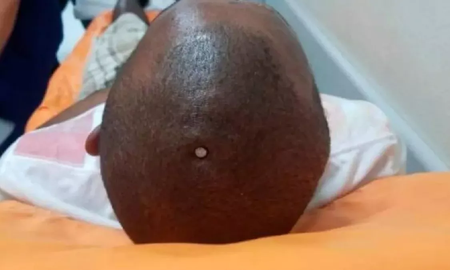 Un hombre se incrustó un clavo en la cabeza porque sentía flojo su cerebro