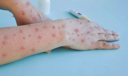 viruela del mono: espana reforzara la vacunacion y vigilancia ante la emergencia internacional viruela del mono: espana reforzara la vacunacion y vigilancia ante la emergencia internacional