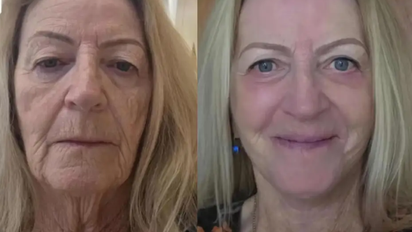 A los 73 años se hizo un lifting facial en Tailandia, rejuveneció 20 años y contó cuánto pagó