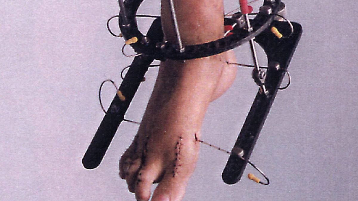 En septiembre de 1993, el reconocido cirujano californiano Kevin Louie le colocó un tutor externo para poder “enderezar” su pierna derecha. “Mick tomó muy poca medicación para el dolor, es casi sobrehumano. Es como si reseteara su termostato del dolor”, dijo el médico, asombrado por la resistencia y fortaleza de su paciente. En septiembre de 1993, el reconocido cirujano californiano Kevin Louie le colocó un tutor externo para poder “enderezar” su pierna derecha. “Mick tomó muy poca medicación para el dolor, es casi sobrehumano. Es como si reseteara su termostato del dolor”, dijo el médico, asombrado por la resistencia y fortaleza de su paciente.