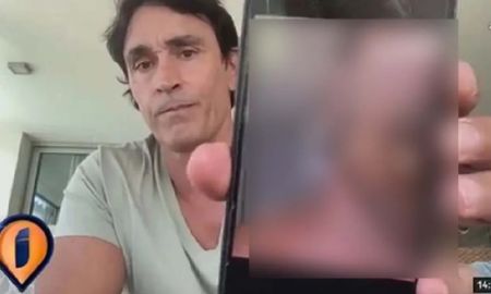 Sebastián Estevanez mostró las fotos de su cara quemada Sebastián Estevanez mostró las fotos de su cara quemada