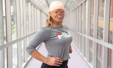 A los siete meses se quemó el 88% del cuerpo y no se resigna a cumplir su gran sueño: Quiero ser modelo A los siete meses se quemó el 88% del cuerpo y no se resigna a cumplir su gran sueño: Quiero ser modelo