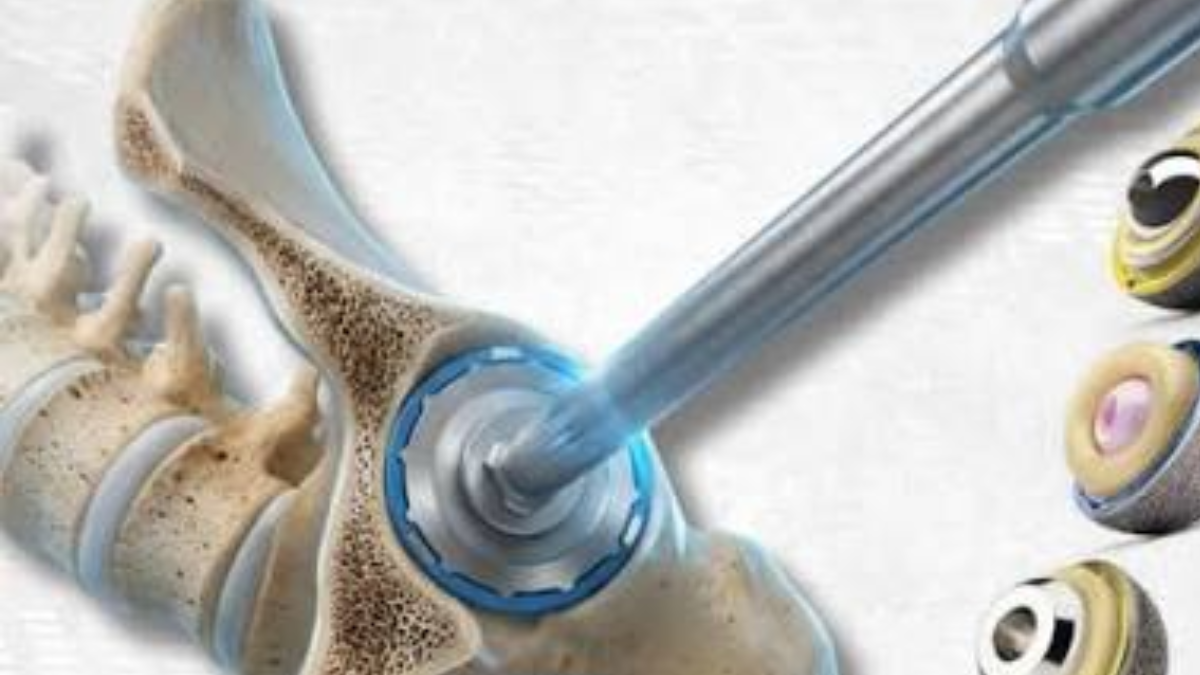 Hallan implantes quirúrgicos falsificados en un control en Santa Fe. Hallan implantes quirúrgicos falsificados en un control en Santa Fe.