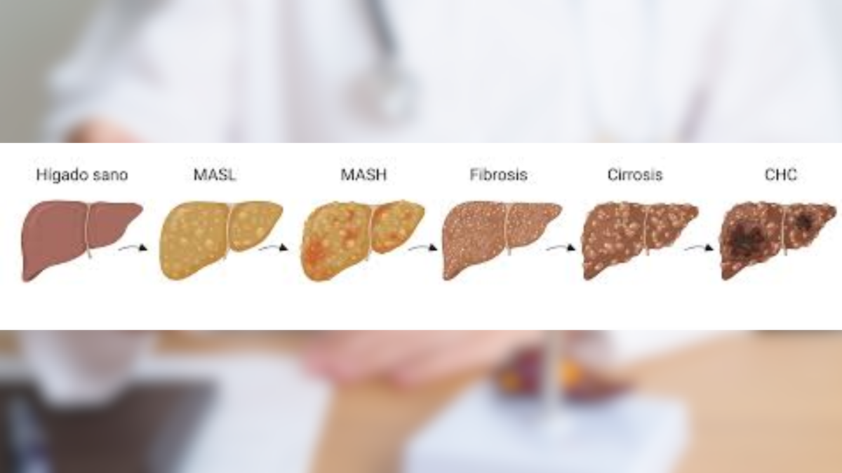 La evolución de la enfermedad hepática metabólica muestra cómo el daño avanza desde la grasa simple hasta la cirrosis o el cáncer. La evolución de la enfermedad hepática metabólica muestra cómo el daño avanza desde la grasa simple hasta la cirrosis o el cáncer.