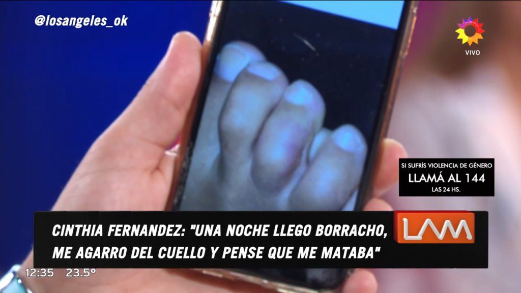 La foto que prueba la violencia física de Matías Defederico