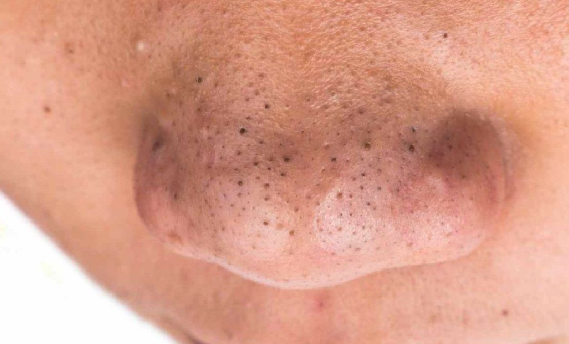 Remedios caseros para quitar los puntos negros de la nariz