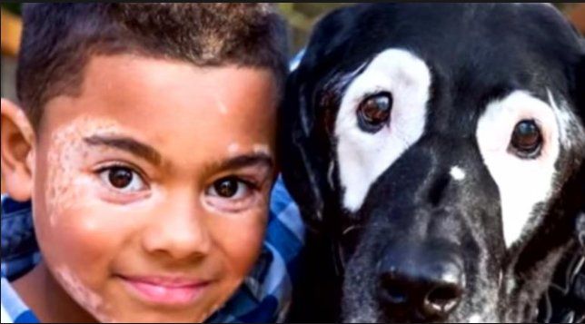 Día Mundial del Vitiligo: qué es y cuáles famosos aprendieron a vivir con la enfermedad