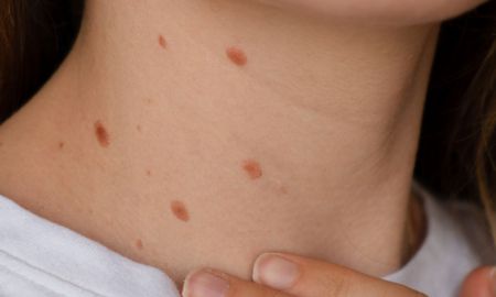 La vacuna contra la varicela previene las formas graves de la enfermedad y sus complicaciones. La vacuna contra la varicela previene las formas graves de la enfermedad y sus complicaciones.
