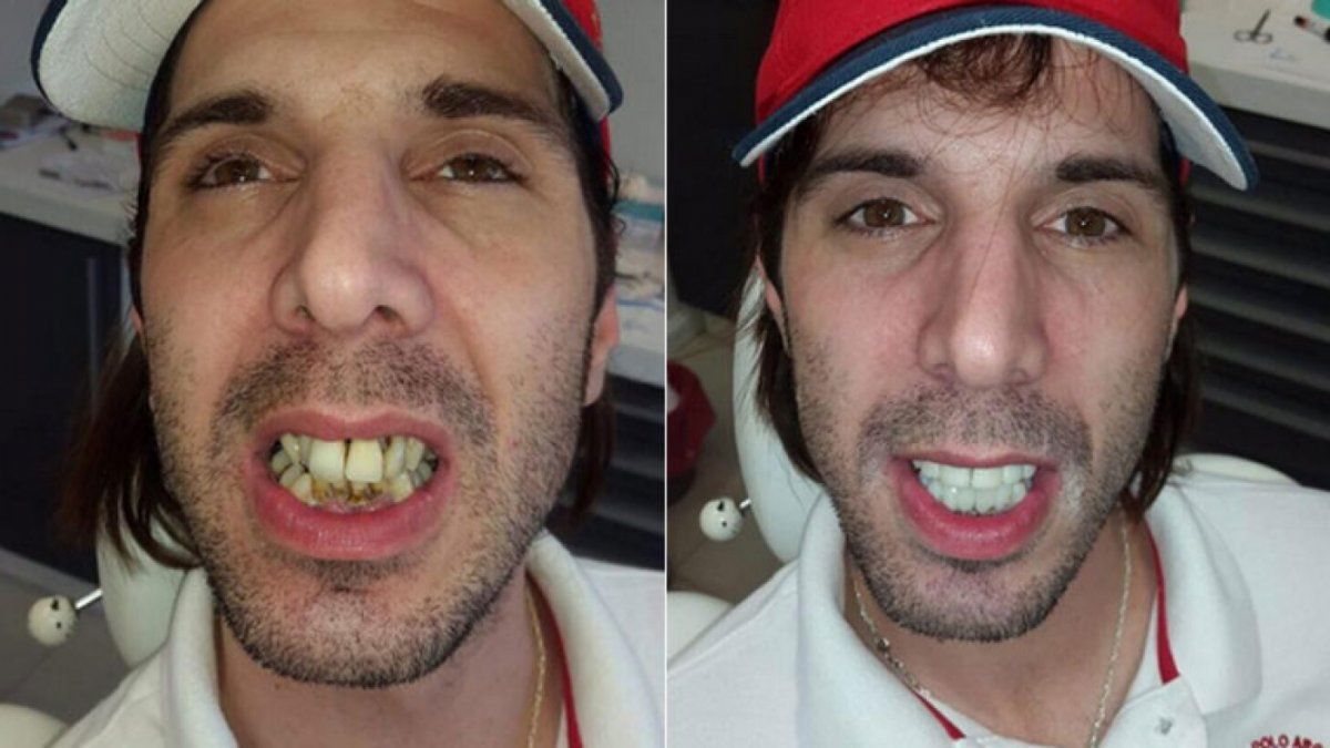 Uno de los cambios físicos más notables fue cuando se colocó carillas en los dientes y lo compartió públicamente. 