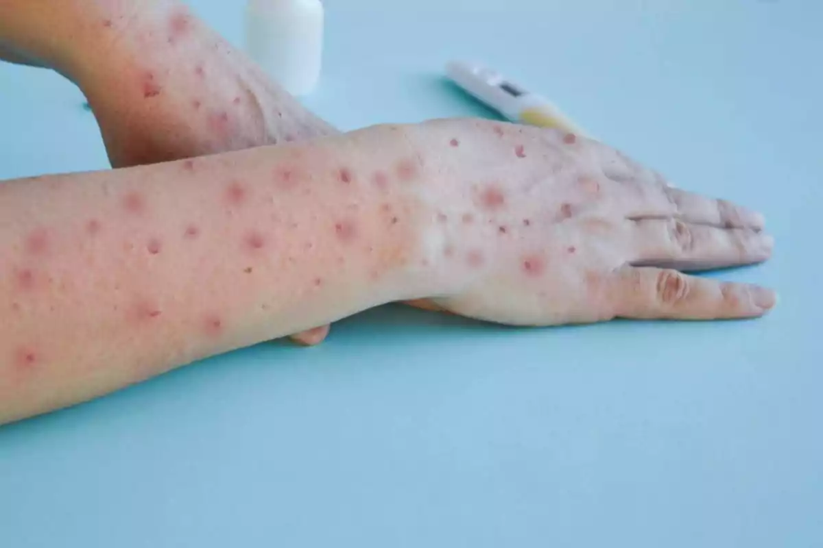 Viruela del mono: España reforzará la vacunación y vigilancia ante la emergencia internacional