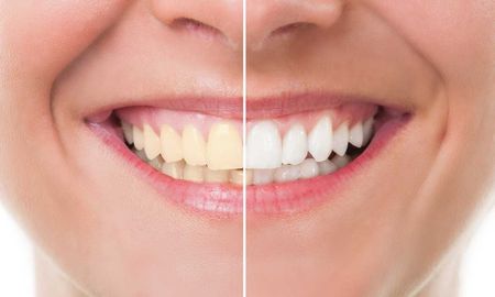 La salud dental es importante para el bienestar general, y el color de nuestros dientes es a menudo una preocupación. La salud dental es importante para el bienestar general, y el color de nuestros dientes es a menudo una preocupación.