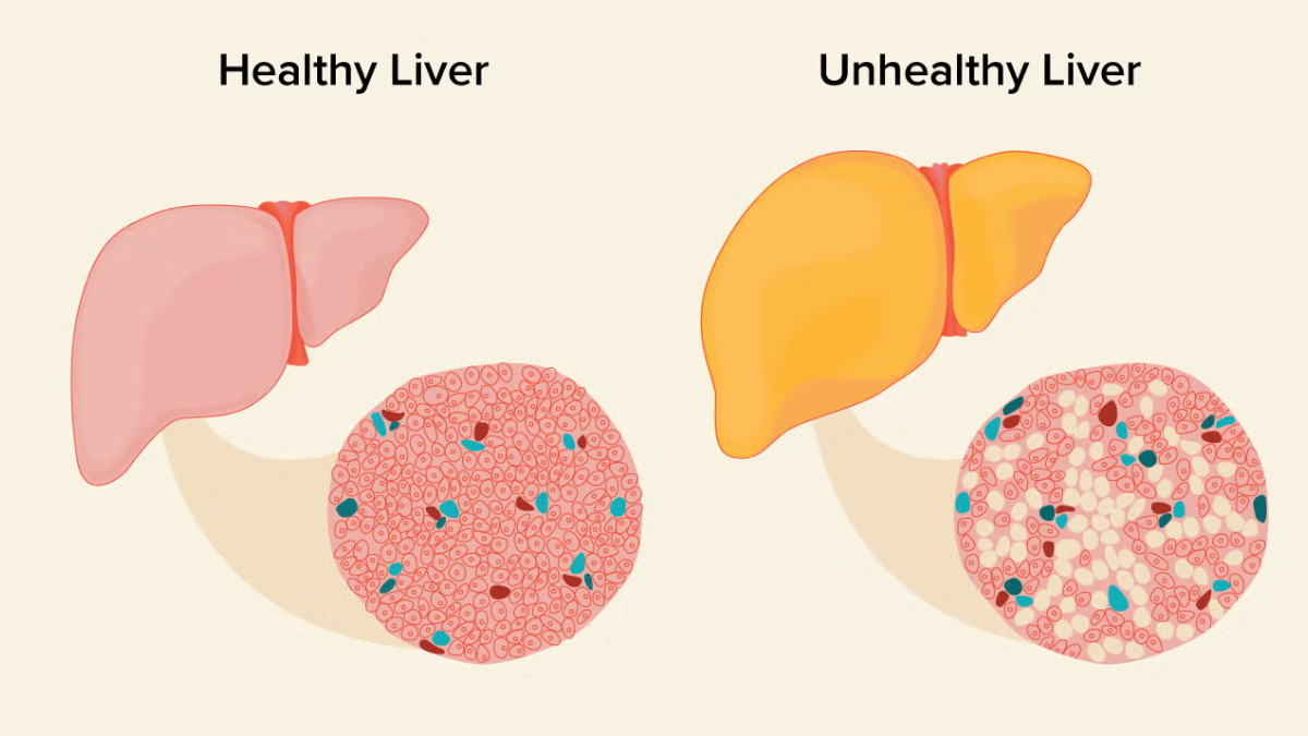 La diferencia entre un hígado sano y uno afectado por la acumulación de grasa se observa claramente en la estructura de sus células. La diferencia entre un hígado sano y uno afectado por la acumulación de grasa se observa claramente en la estructura de sus células.