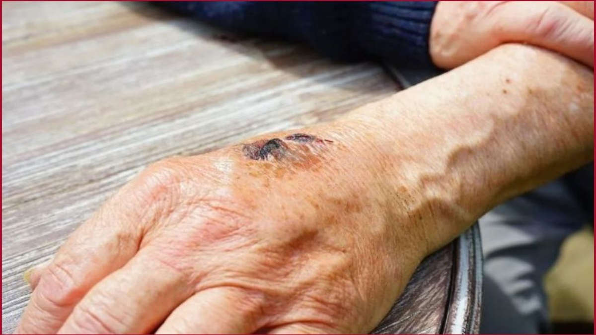 Viruela del mono: cuáles son los síntomas