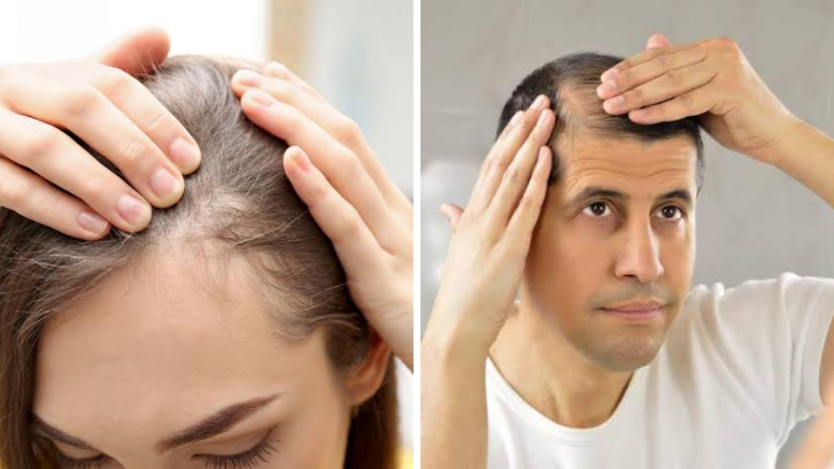 La caída del pelo casi siempre es motivo de consulta en las visitas al dermatólogo y al endocrinólogo. La caída del pelo casi siempre es motivo de consulta en las visitas al dermatólogo y al endocrinólogo.
