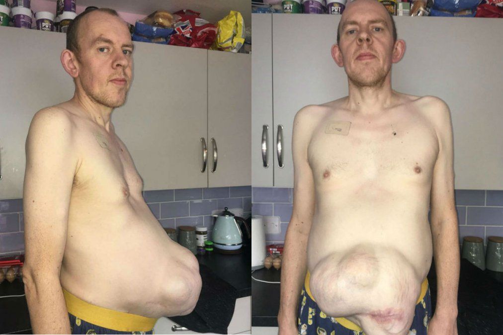Estuvo al borde de morir por cinco hernias gigantes que lo hacen “lucir embarazado”