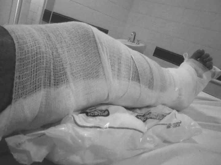 La pierna de Sergio mientras aguardaba a ser trasladado de Castelli a Sáenz Peña.