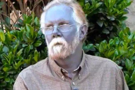 La metahemoglobinemia, una rara enfermedad.