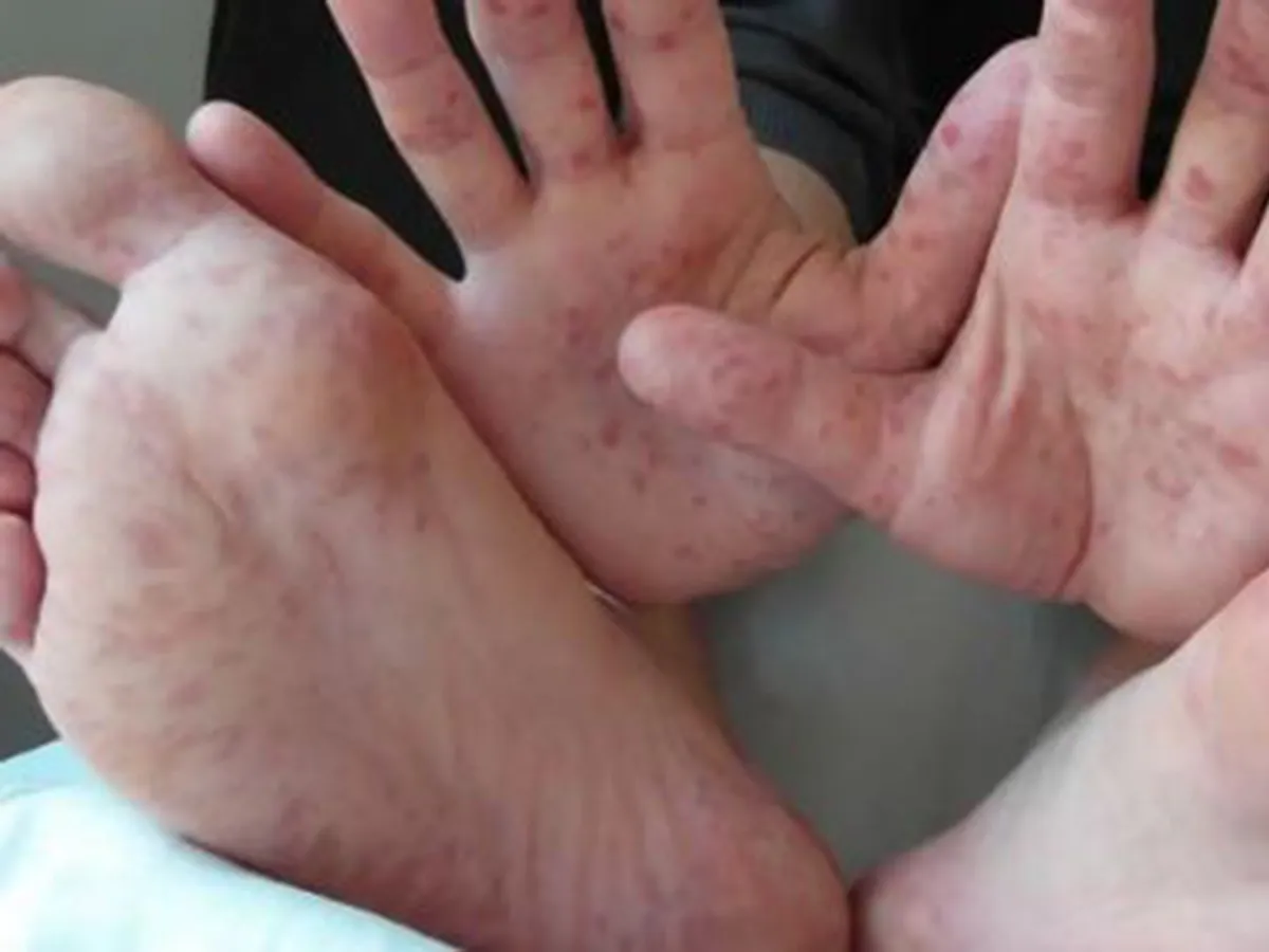 ¿Cuáles son los síntomas de infecciones por virus de Coxsackie?