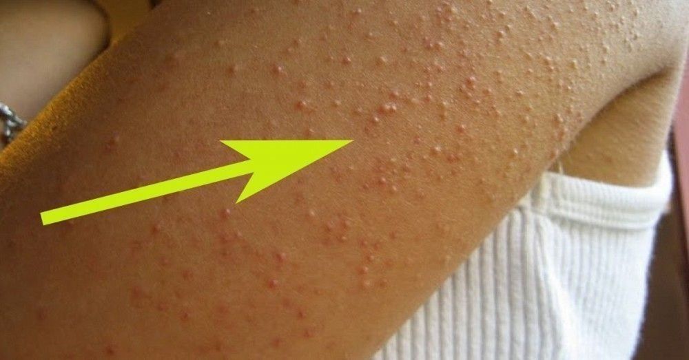 ¿Tenés estos granitos en el brazo? Mirá por qué salen y cómo desaparecerlos