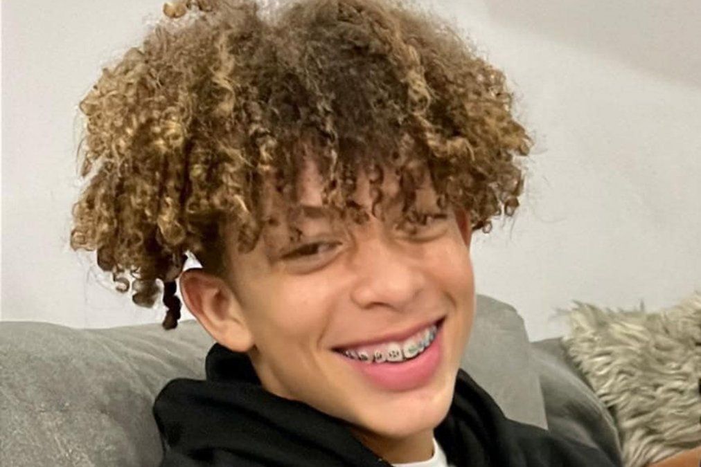 Realizó un desafío de TikTok y terminó con el 80% del cuerpo quemado