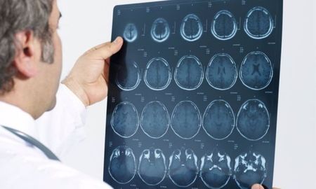 El linfoma cerebral es un tipo de cáncer que afecta el cerebro. El linfoma cerebral es un tipo de cáncer que afecta el cerebro.