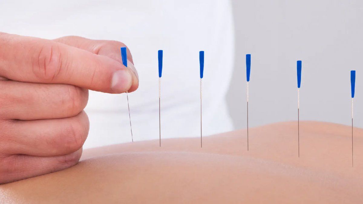 Mitos y verdades sobre la acupuntura
