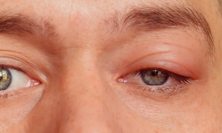 Con estos simples pasos, podés tratar y prevenir los orzuelos para cuidar la salud de tus ojos y evitar molestias innecesarias. Con estos simples pasos, podés tratar y prevenir los orzuelos para cuidar la salud de tus ojos y evitar molestias innecesarias.