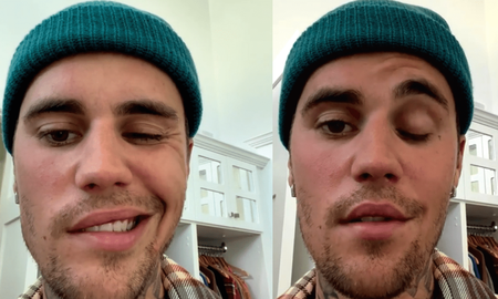 Qué es el síndrome de Ramsay Hunt que sufre Justin Bieber Qué es el síndrome de Ramsay Hunt que sufre Justin Bieber