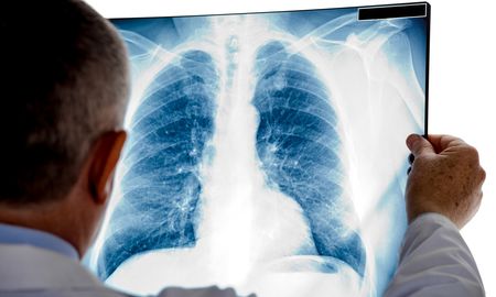 Unas 10.279 personas fallecieron en 2020 a causa del cáncer de pulmón en Argentina, una enfermedad que el 80% de las personas que la padecen son fumadoras. Unas 10.279 personas fallecieron en 2020 a causa del cáncer de pulmón en Argentina, una enfermedad que el 80% de las personas que la padecen son fumadoras.