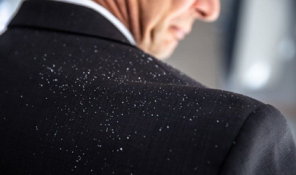 5 alimentos que te ayudarán a eliminar la caspa