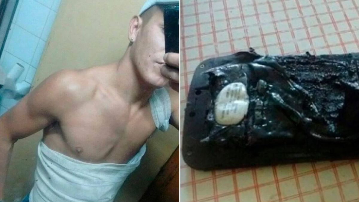 Córdoba: le explotó el celular mientras dormía y sufrió quemaduras en todo su cuerpo