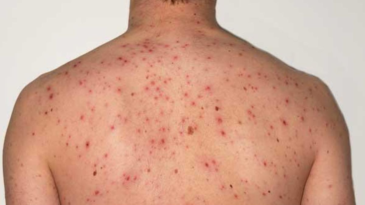 Argentina cuenta con 127 casos confirmados de viruela símica.