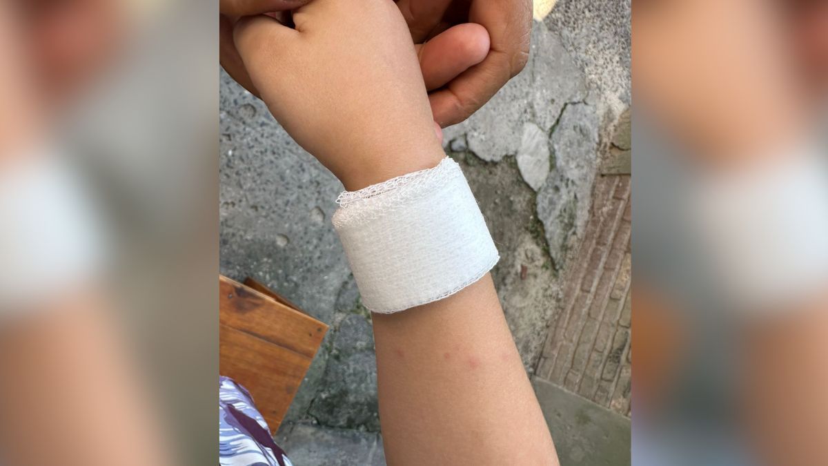 El pitbull mordió al nene de dos años en el brazo, que fue curado en el Hospital Alassia. El pitbull mordió al nene de dos años en el brazo, que fue curado en el Hospital Alassia.
