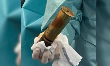 Evacúan hospital en Toulouse por proyectil de la Primera Guerra Mundial alojado en un paciente Evacúan hospital en Toulouse por proyectil de la Primera Guerra Mundial alojado en un paciente