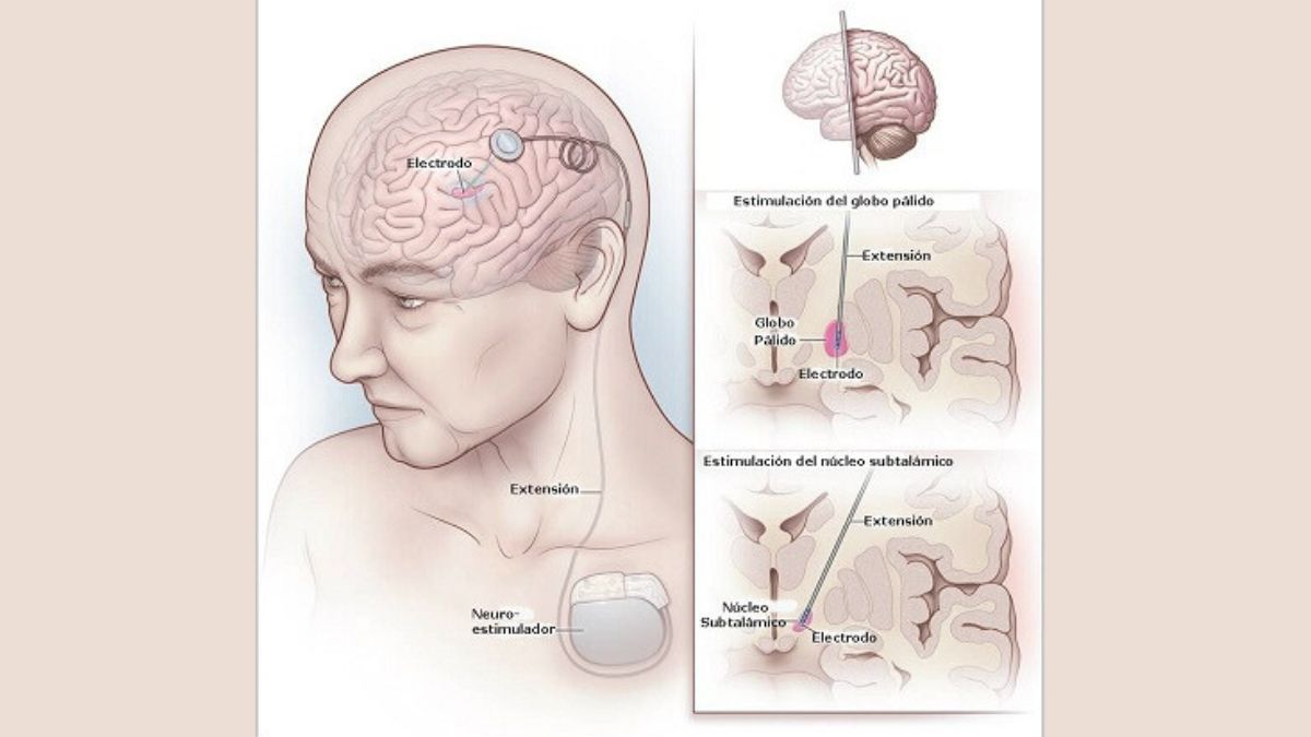 La intervención consiste en colocar un electrodo muy fino en una zona profunda afectada. 
