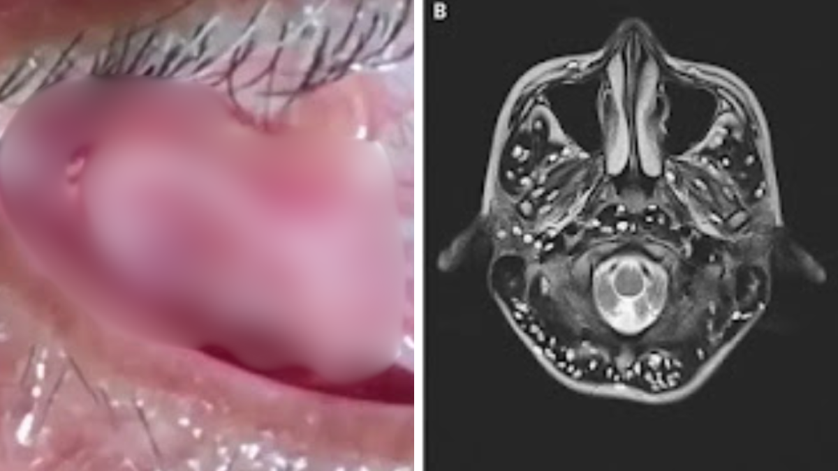 Una mujer pidió asistencia médica para su hija al descubrir que tenía gusanos en la cabeza.