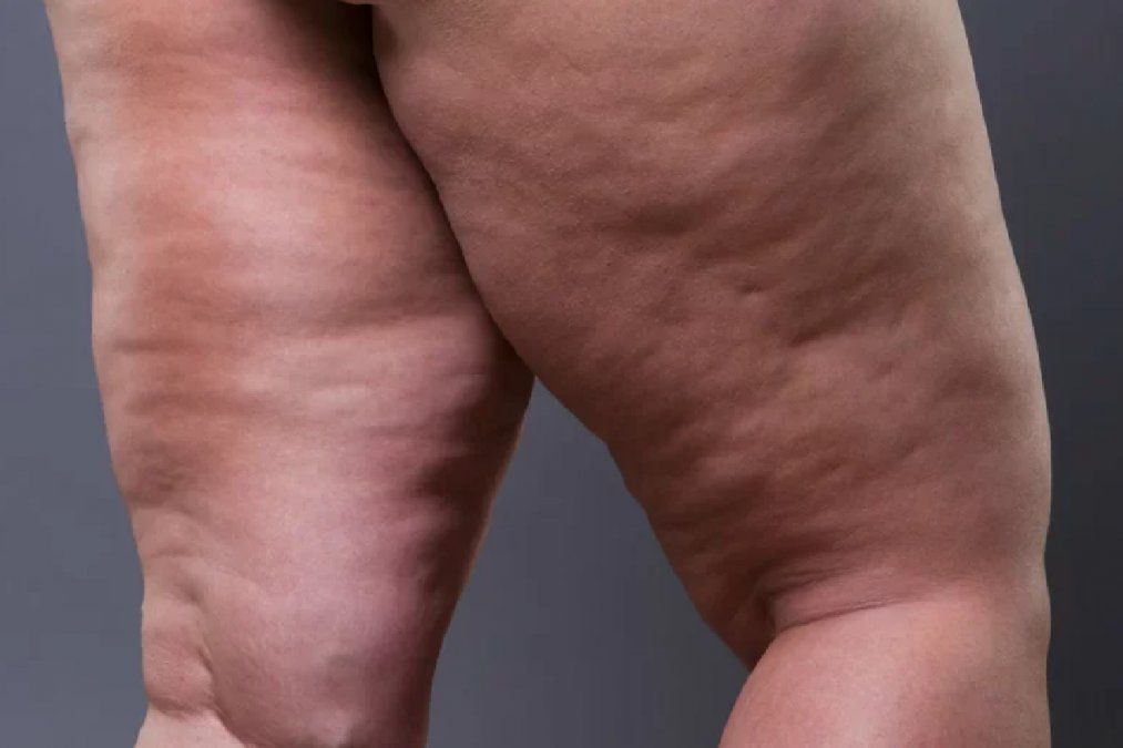 Los pantalones ajustados pueden causar celulitis: razones para darle un respiro a las piernas