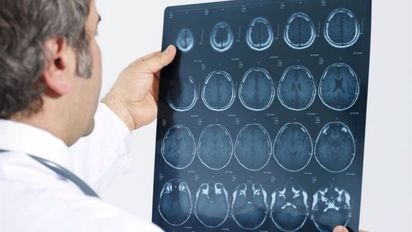 Qué es el linfoma cerebral: el tipo de cáncer que tiene el cantante Raphael