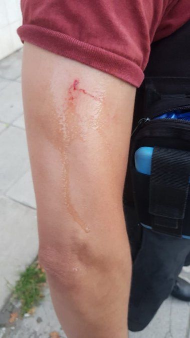 El otro brazo mordido