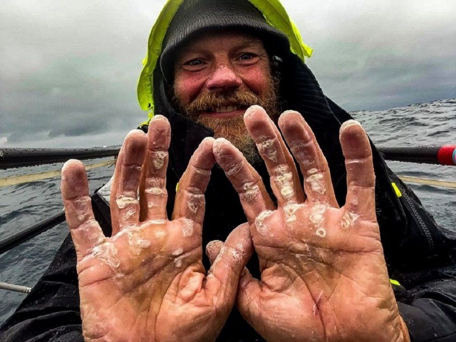 Un hombre cruzó solo el Atlántico a remo y sus manos quedaron en un terrible estado.
