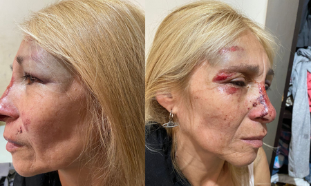La víctima del violento robo sufrió graves heridas en su rostro. La víctima del violento robo sufrió graves heridas en su rostro.