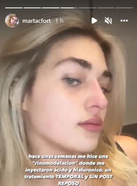 Martita Fort mostró el resultado de su retoque estético sin bisturí.