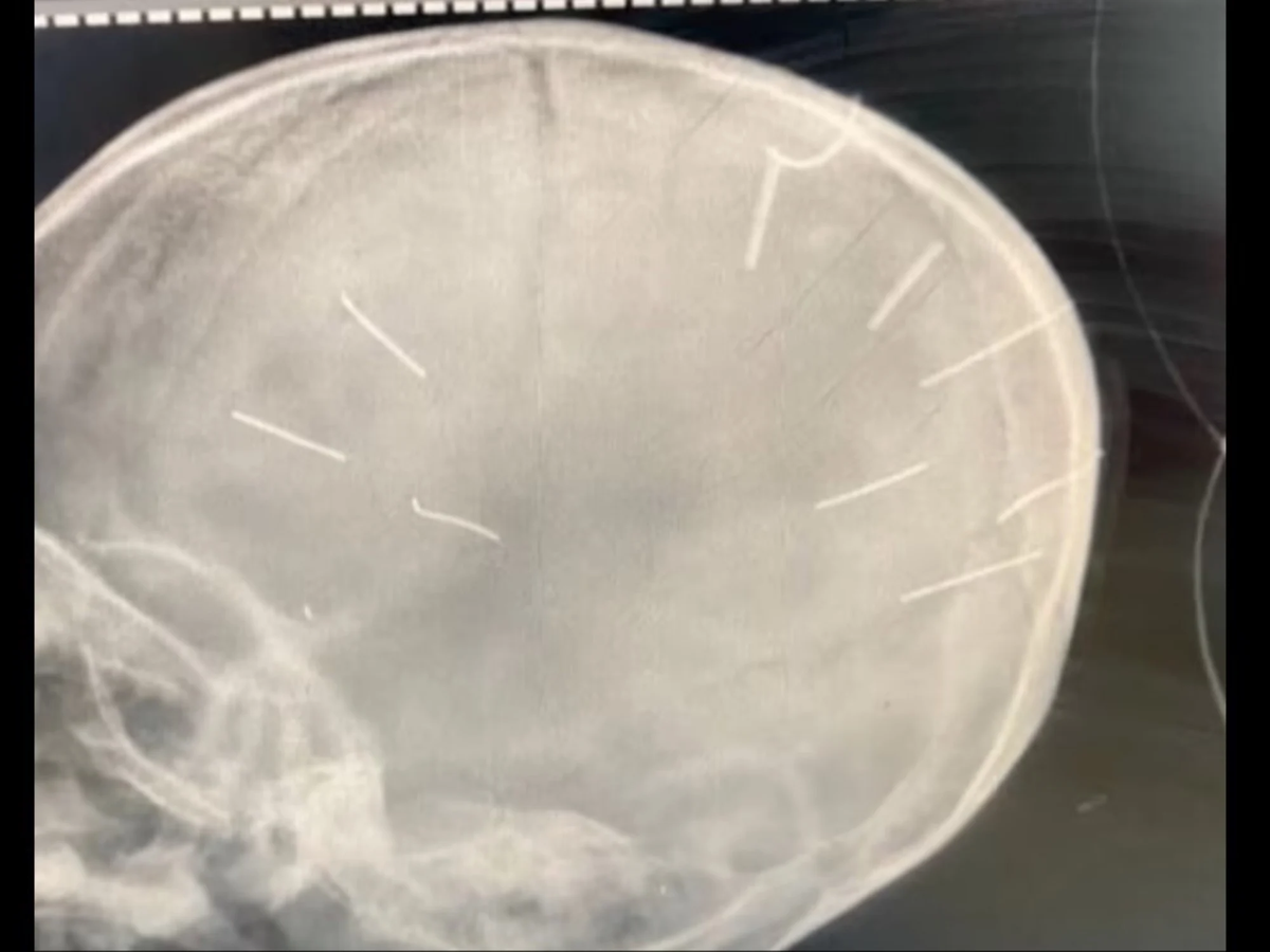 Martilló 9 clavos en el cráneo de la hija de tres años de su novia: no habrá piedad con él