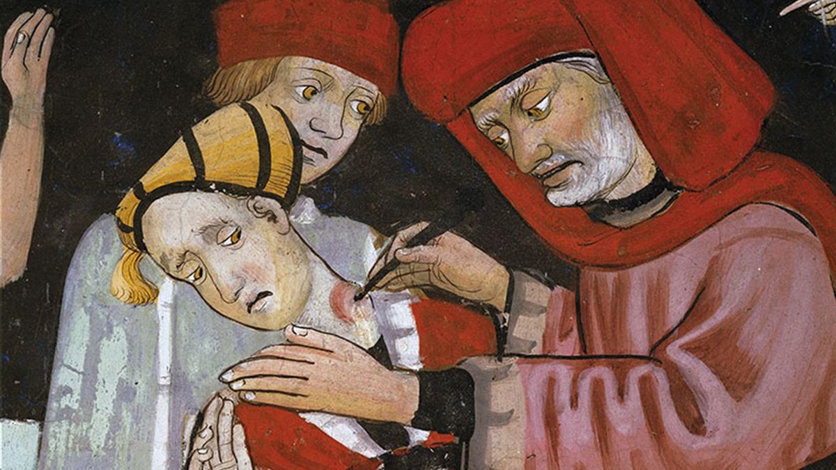 Las infecciones por Peste Negra eran grandes bubones que salían por todo el cuerpo.