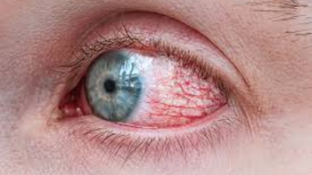 Glaucoma: por qué los especialistas lo llaman