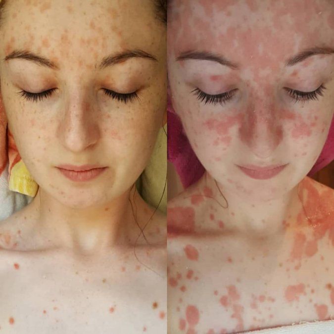 Le hacía bullying y sufrió el desprendimiento del 85% de su piel