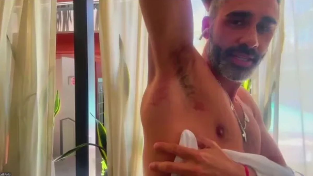 El Pollo Álvarez mostró cómo quedó tras el accidente en Estados Unidos. El Pollo Álvarez mostró cómo quedó tras el accidente en Estados Unidos.